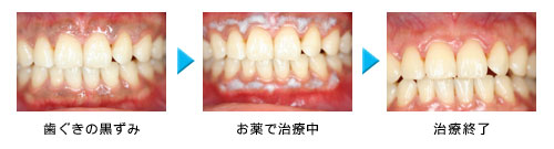 歯ぐきの黒ずみ→お薬で治療中→治療終了