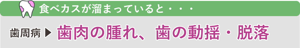 食べカスが溜まっていると、歯周病から歯肉の腫れ、歯の動揺・脱落へ