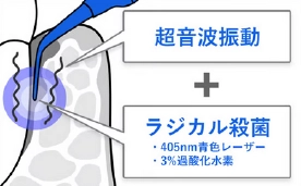 超音波振動とラジカル殺菌