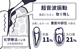 化学療法が必要。超音波振動、重度になるにつれて取り残し。
